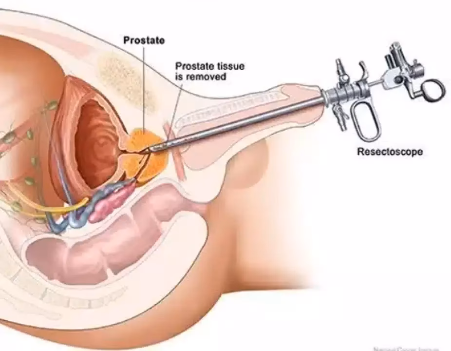 Quelle est la chronologie de récupération après une chirurgie radicale de la prostate ?