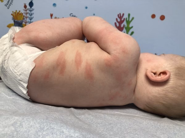 Is winter squash allergenic?