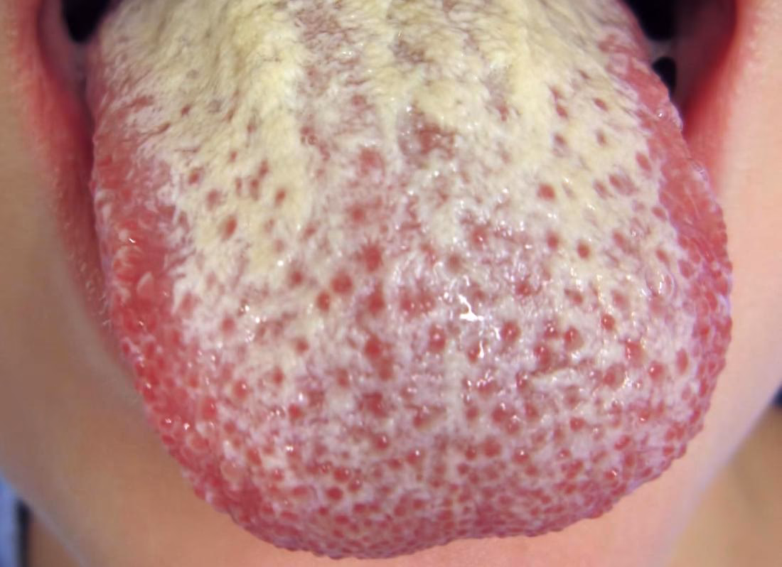 Can a yeast infection be passed from one person to another?