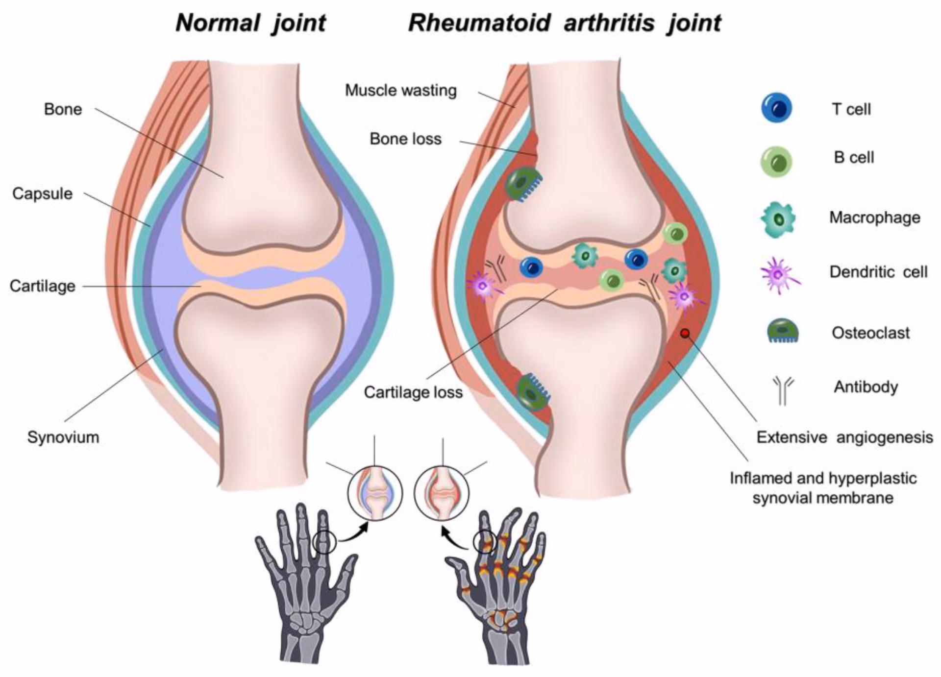 What is 14-3-3 in rheumatoid arthritis (RA)?