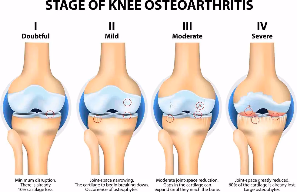 What are the stages of rheumatoid arthritis?