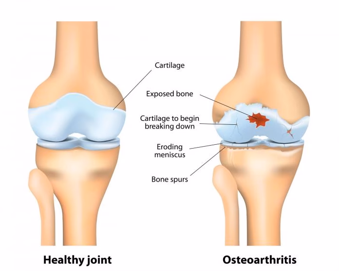 Does a 40-year-old person have osteoarthritis?
