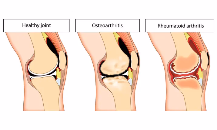 Does a 40-year-old person have osteoarthritis?