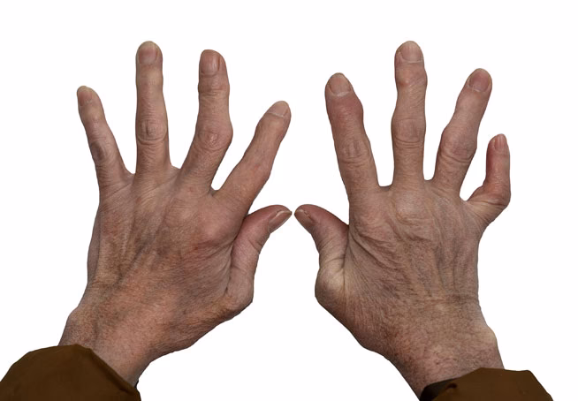 What are the treatment options for osteoarthritis of the hands?