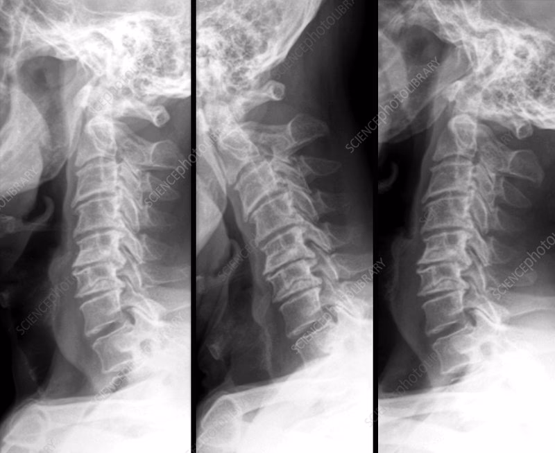 How is CS diagnosed in rheumatoid arthritis (RA)?