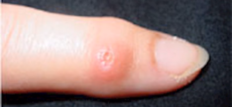 Can osteoarthritis cause a bone cyst?