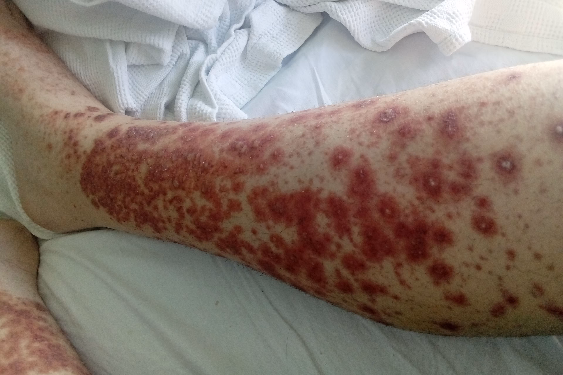 What is gonococcemia (gonococcal arthritis-dermatitis syndrome)?