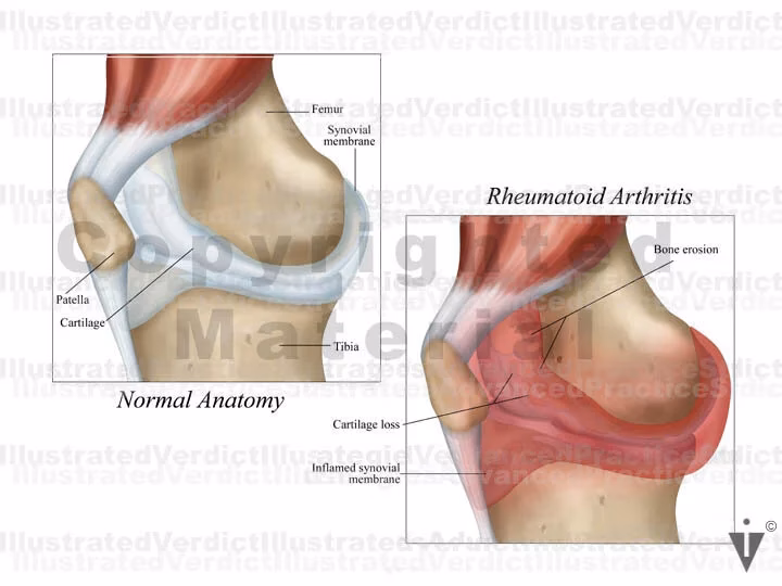 Do fibroblasts promote fibrosis in rheumatoid arthritis?