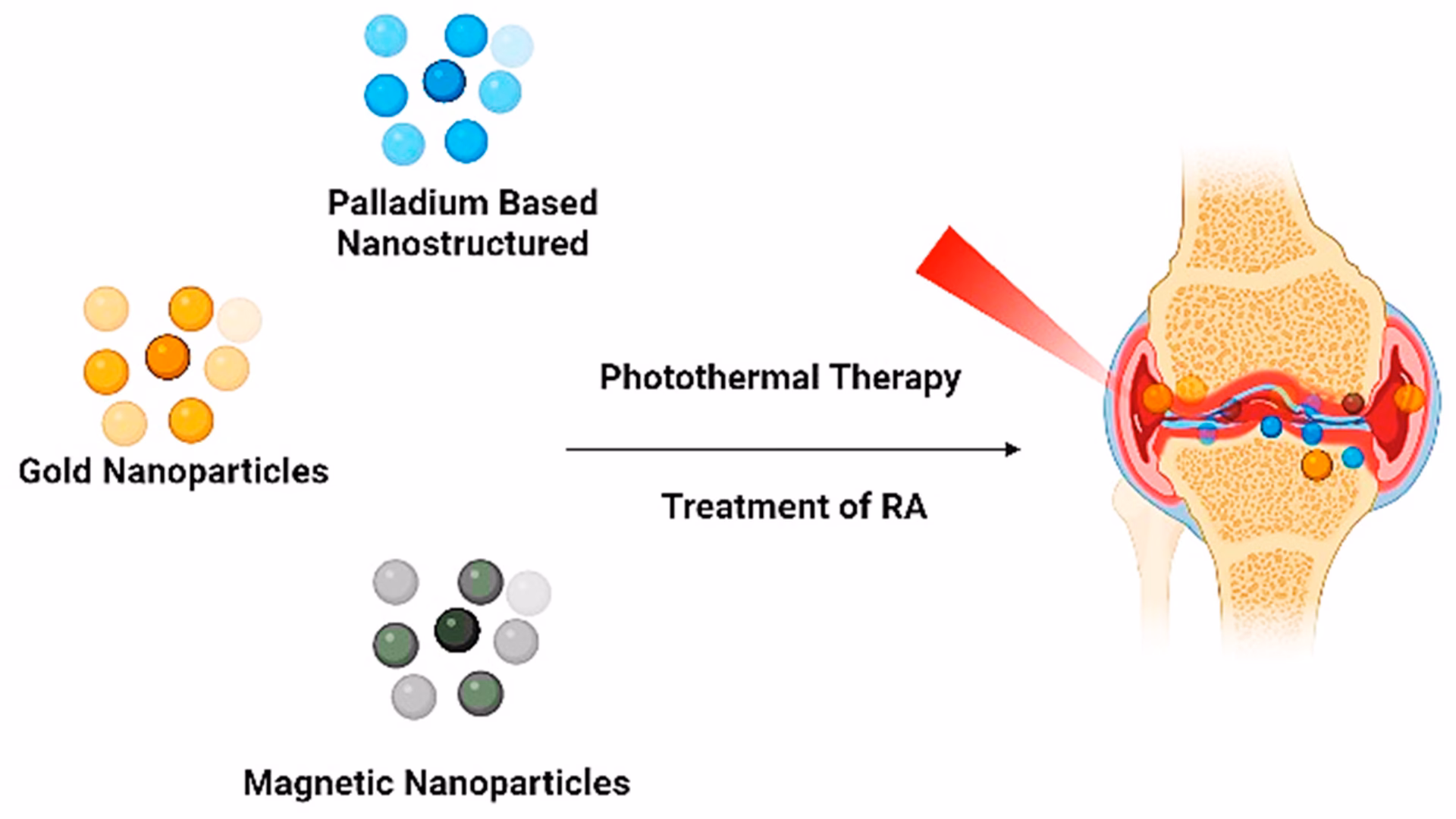 What is gold therapy for rheumatoid arthritis?