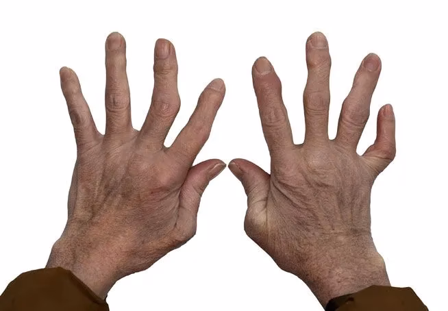 What are the symptoms of hand osteoarthritis?