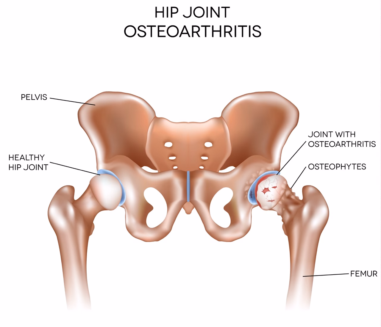 What are the symptoms of hip osteoarthritis?