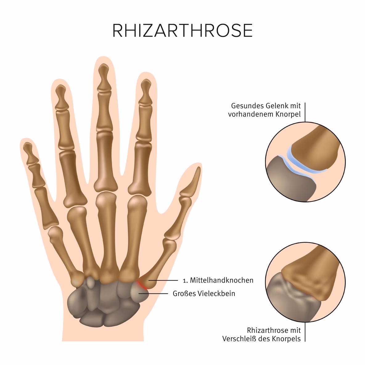 Was ist eine daumenarthrose?