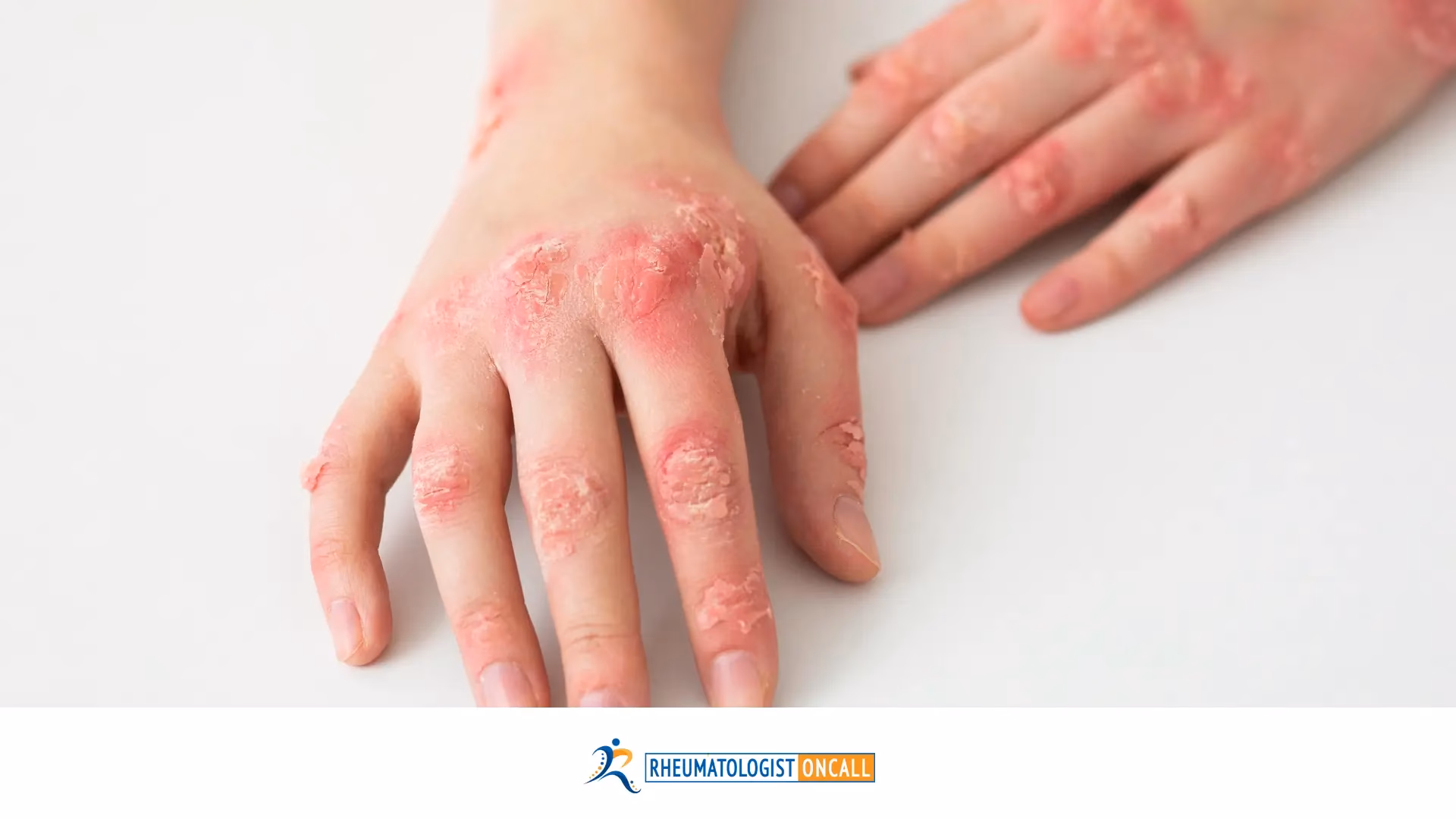 Can lupus cause osteoarthritis?