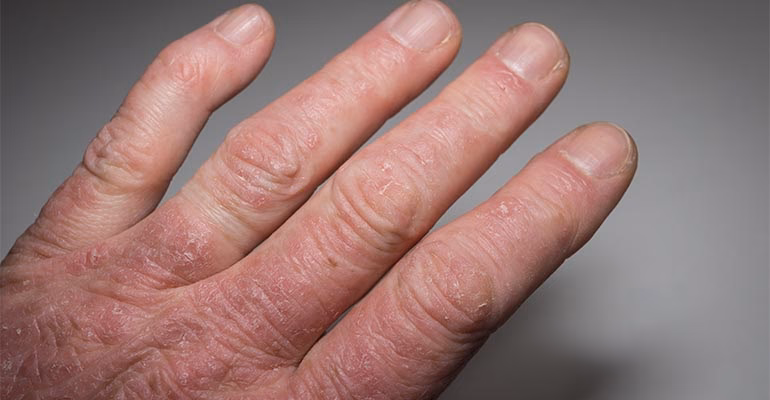 Wat is een reumatische artritis?