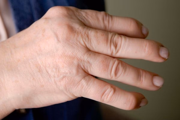 What conditions are related to arthritis?