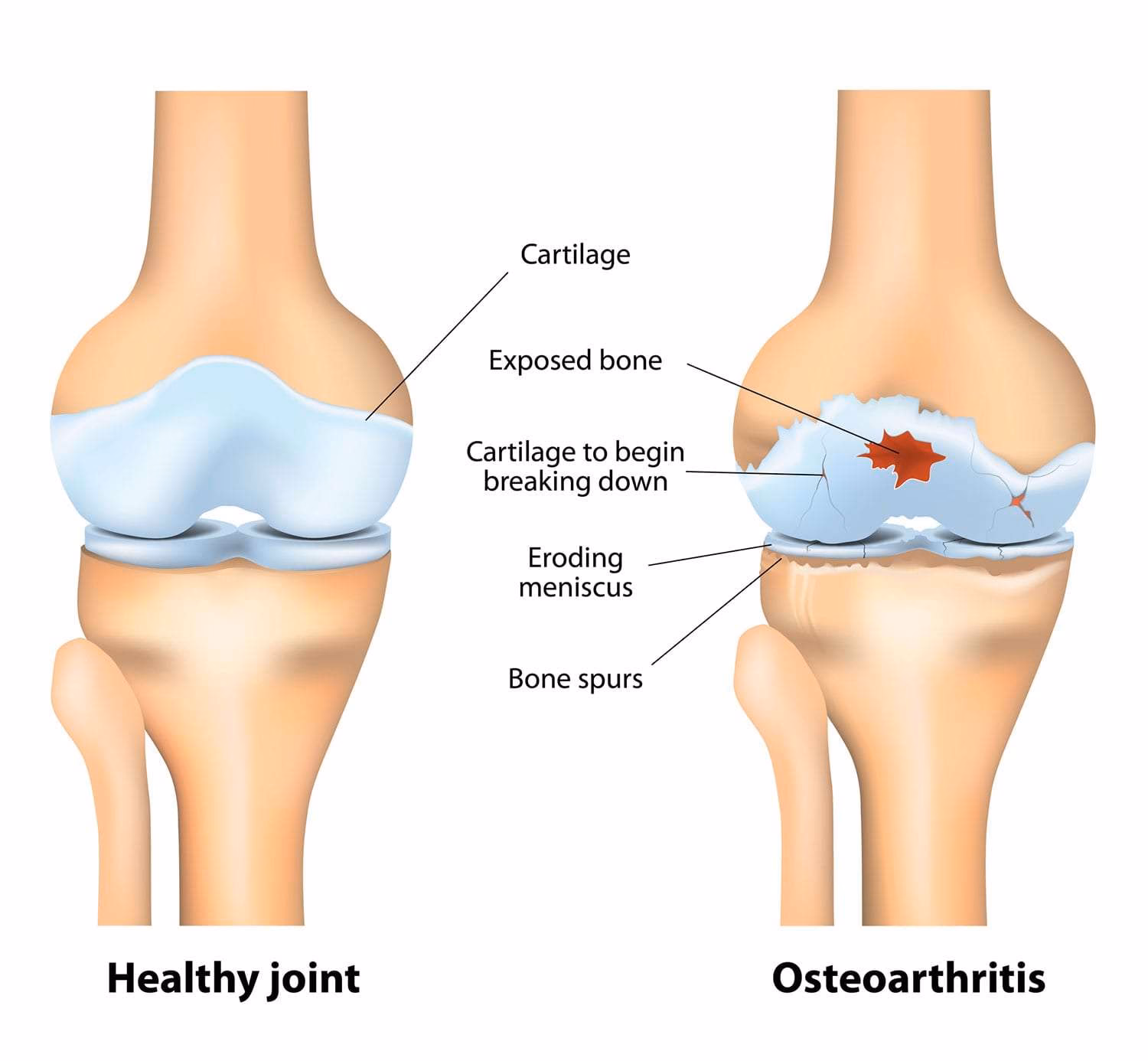 Does osteoarthritis affect women over 50?
