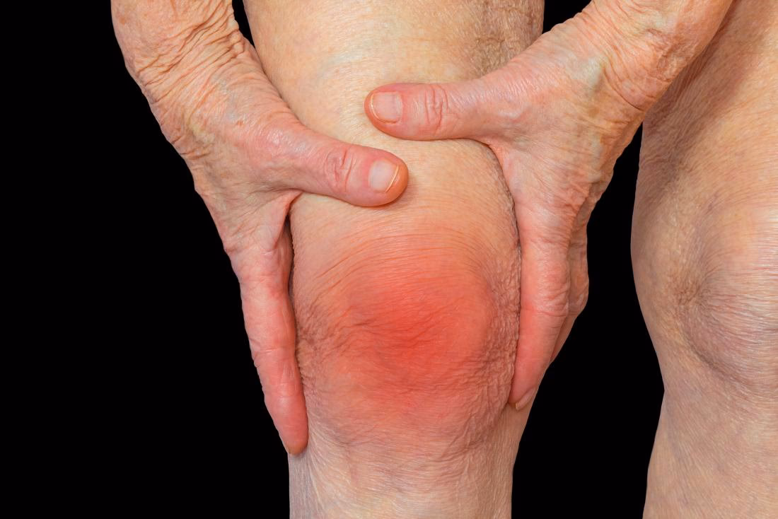 ¿Cuáles son los tratamientos para la artritis?