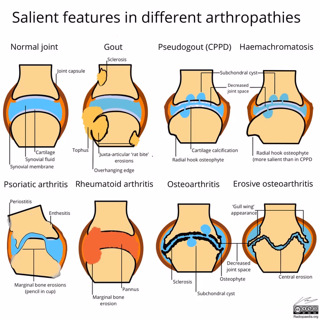 Do radiographs show rheumatoid arthritis?