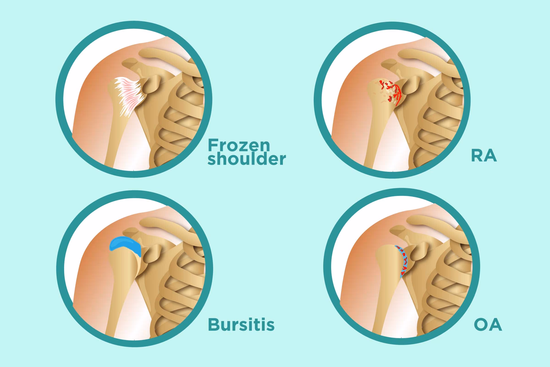 What are the treatment options for shoulder arthritis?