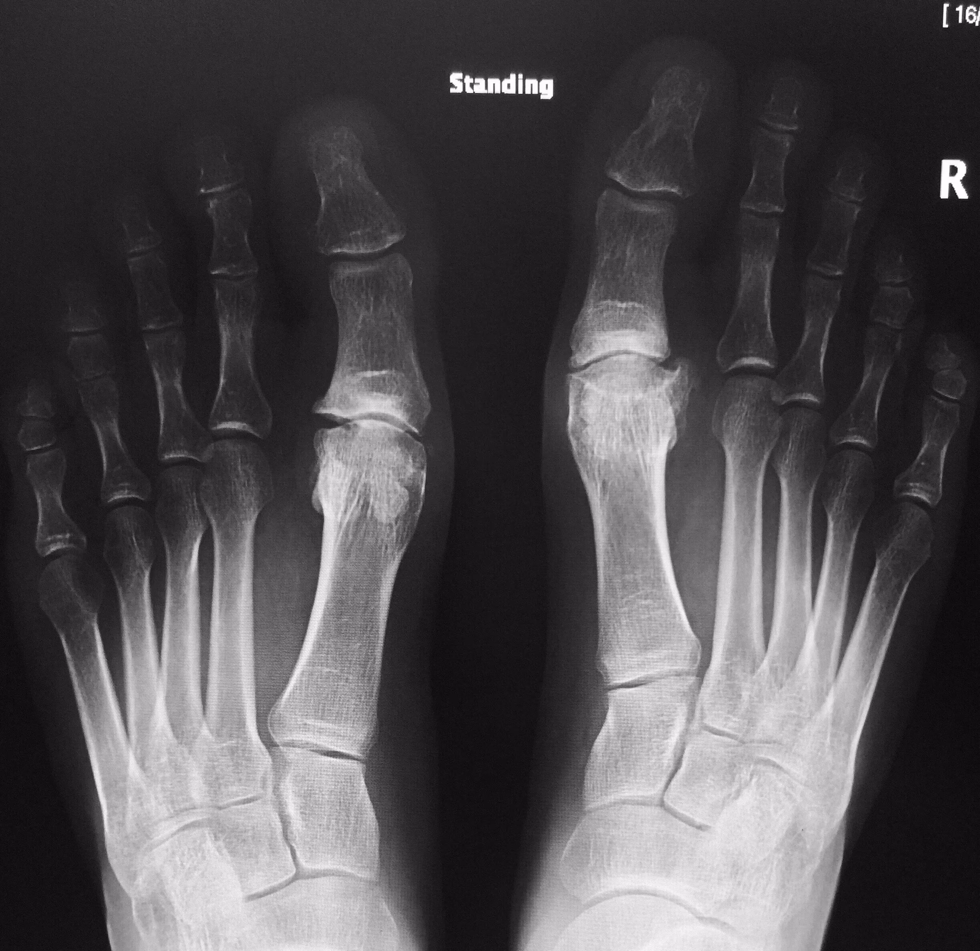 Is radiographic OA associated with foot symptoms?
