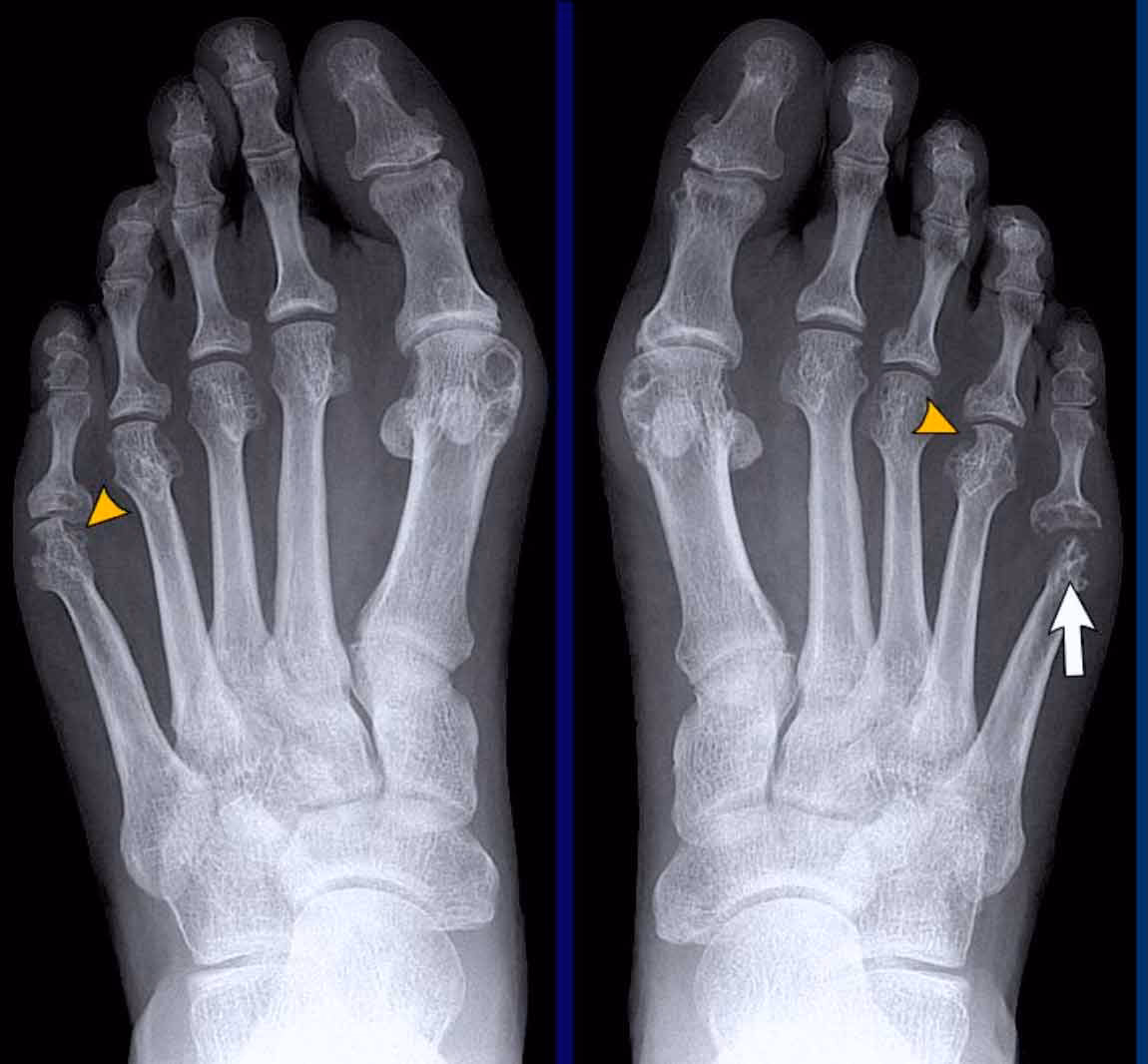 What are radiological findings a rticular arthritis?
