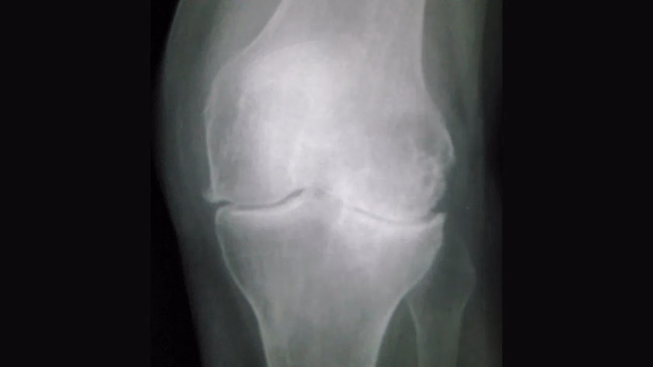 Do X-rays help with knee osteoarthritis?
