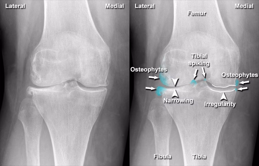 Can a joint test reveal a specific type of arthritis?