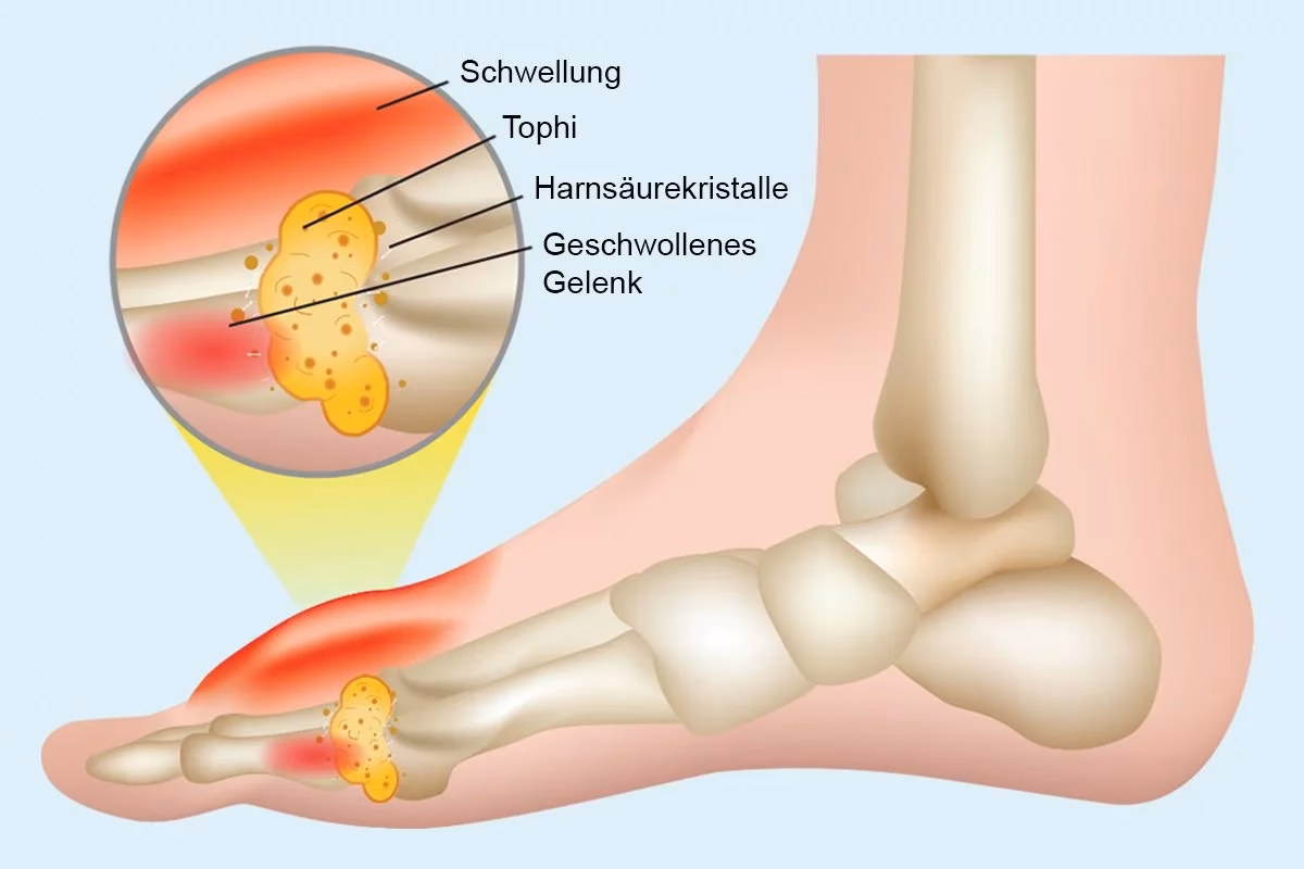 Was ist eine chronische rheumatoide Arthritis?