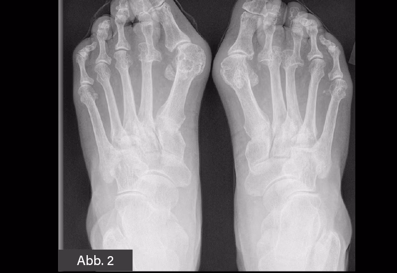 Welche Therapien gibt es für das Großzehengrundgelenk?