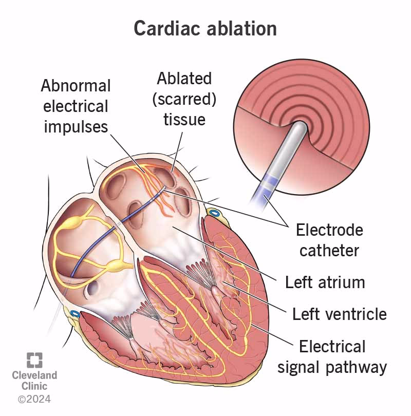 How do you treat atrial fibrillation (AFIB)?
