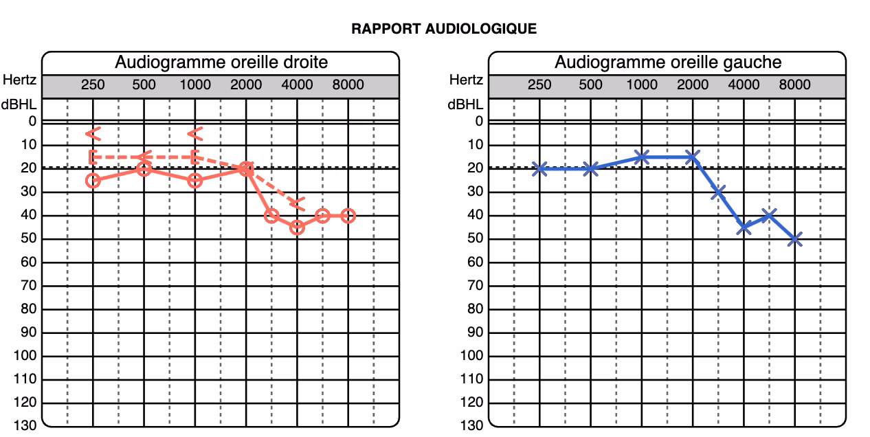What are the standard audiogram symbols?