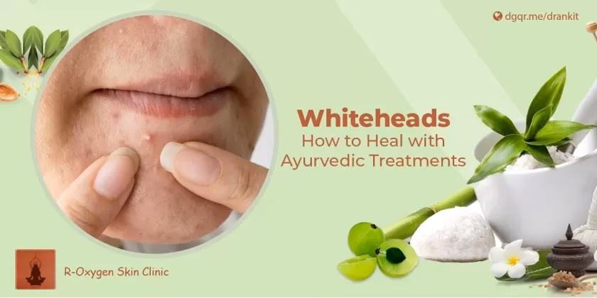 Can Ayurveda help with acne?