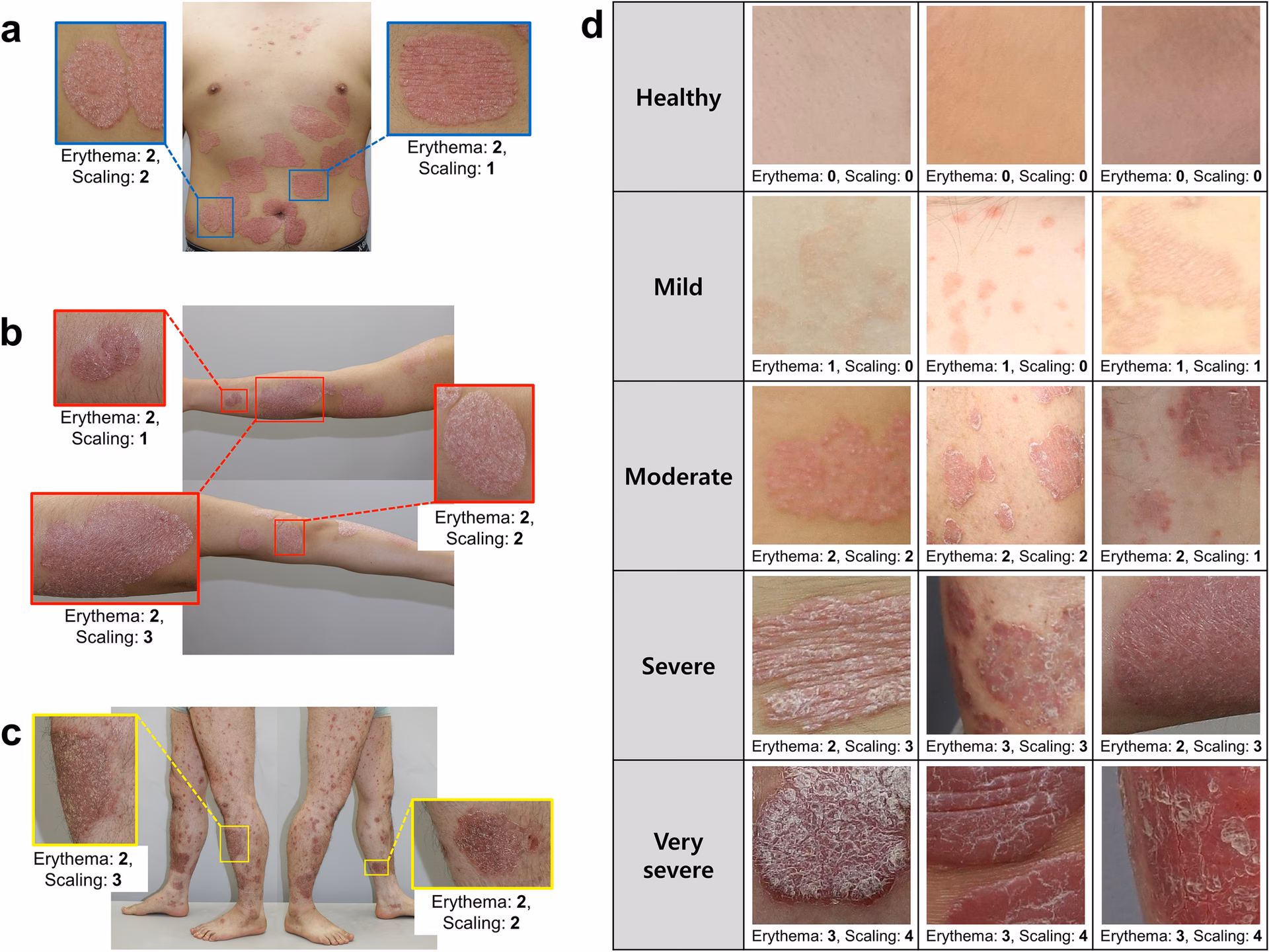 What is the best psoriasis treatment?