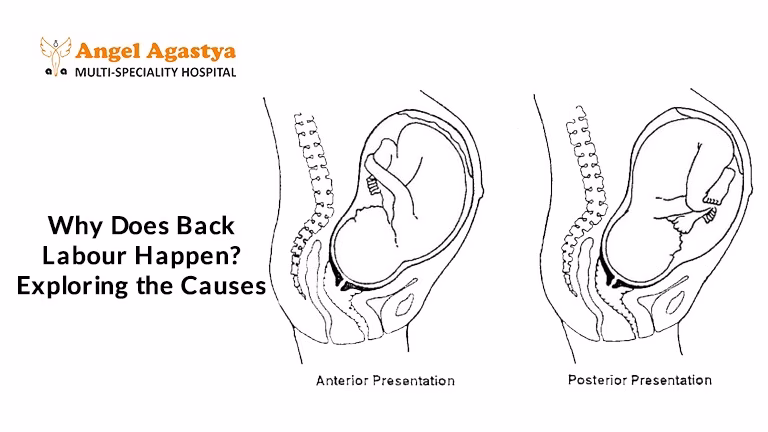How to relieve back pain during labor?