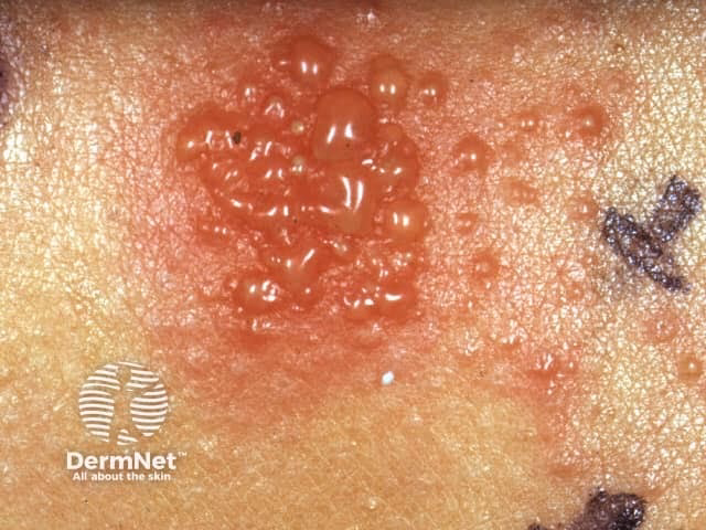 Can jewelry cause a nickel allergy?