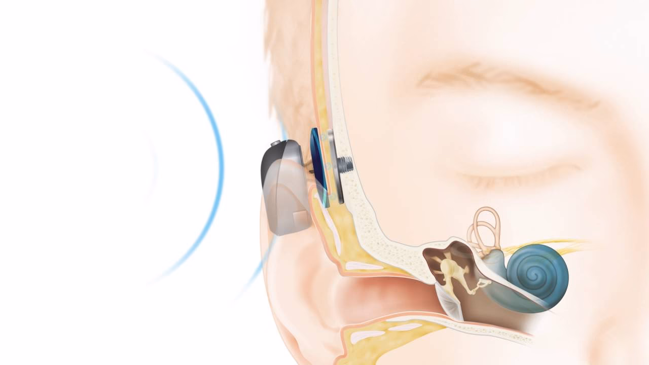 Can a Baha help a woman with single side deafness?