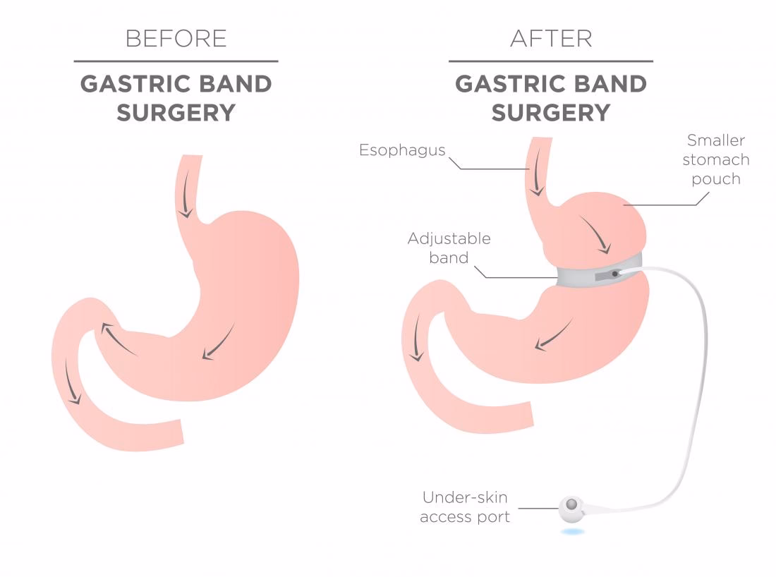 How does a pulmonary artery band work?