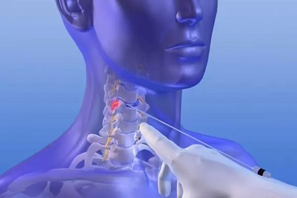 Was tun nach einer Bandscheiben-OP?