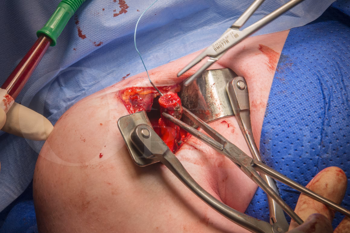 What is a bare spot?