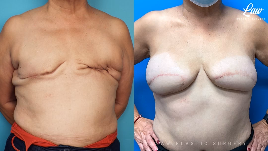 Should I get a breast augmentation or a lift?