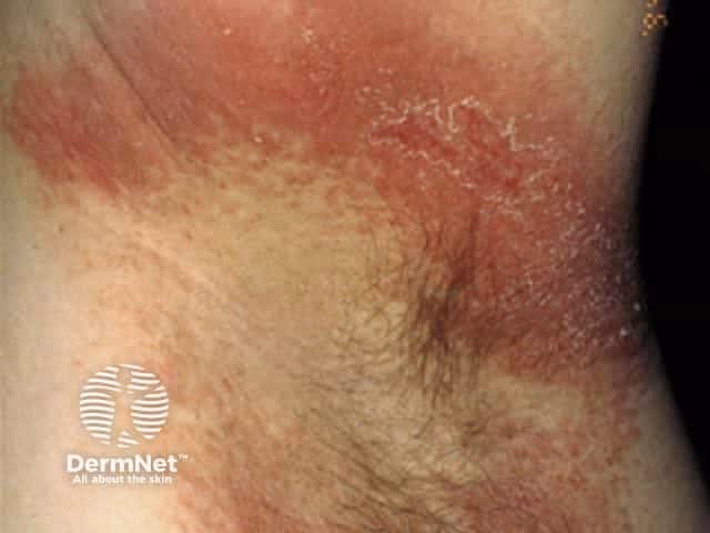 Can benzoates cause a swollen skin?
