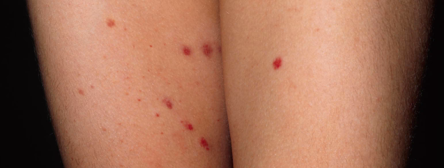 Hvad er en blodudtrædning?