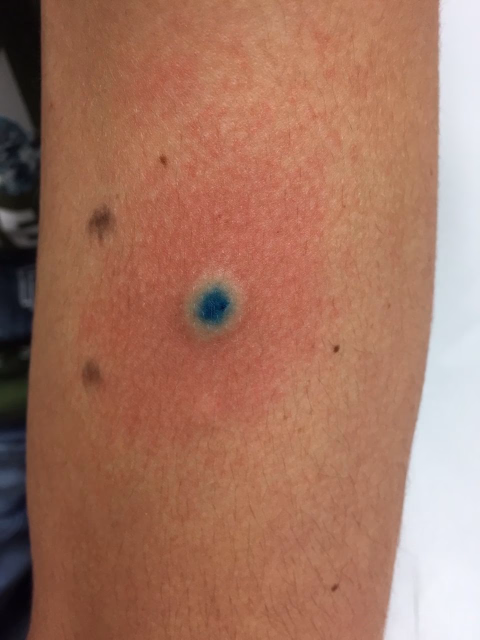 Can blue 1 cause allergic reactions?