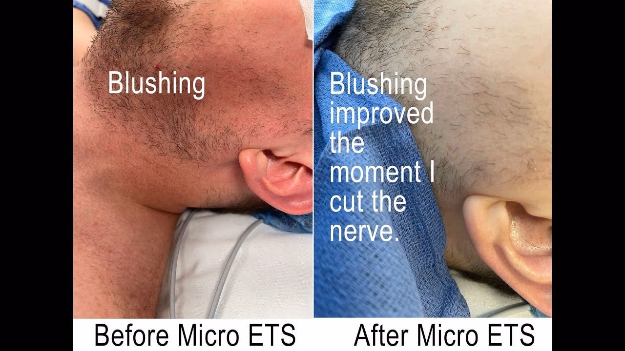 Does surgery cure blushing?