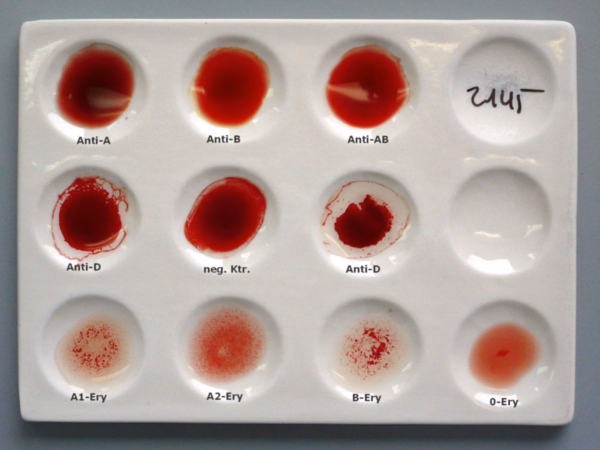 Wie hoch ist der Normalwert der Blutgruppe?