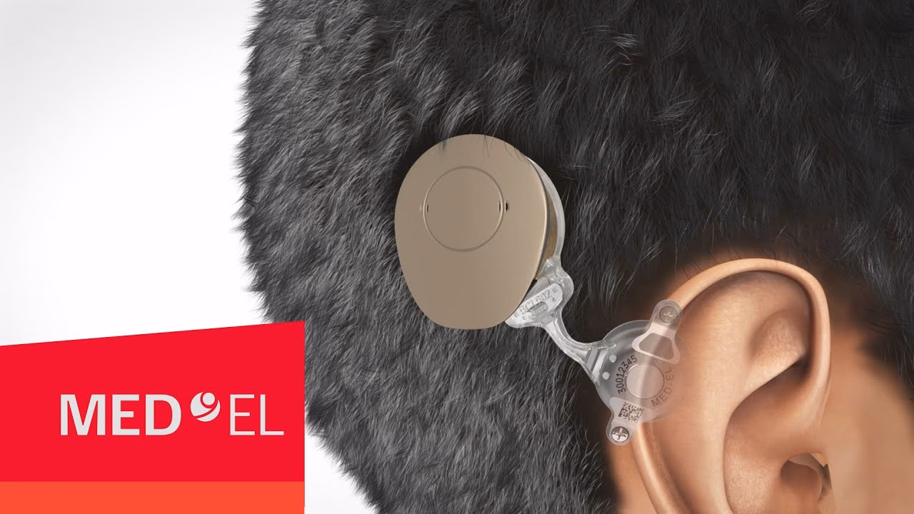 What is a Bonebridge implant?