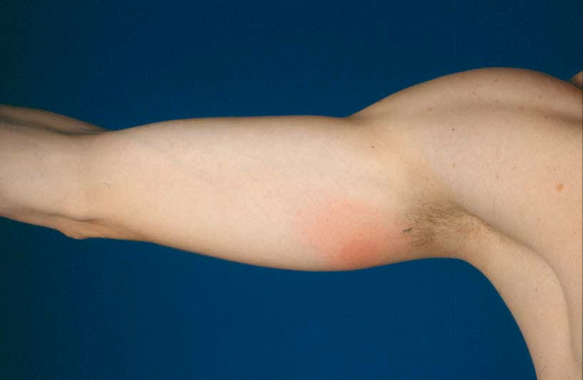 Hva er antibiotika for Borrelia?