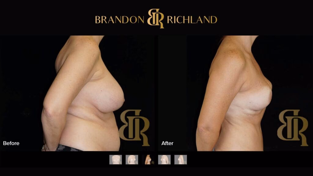 How do I know if I have a fat transfer breast augmentation?