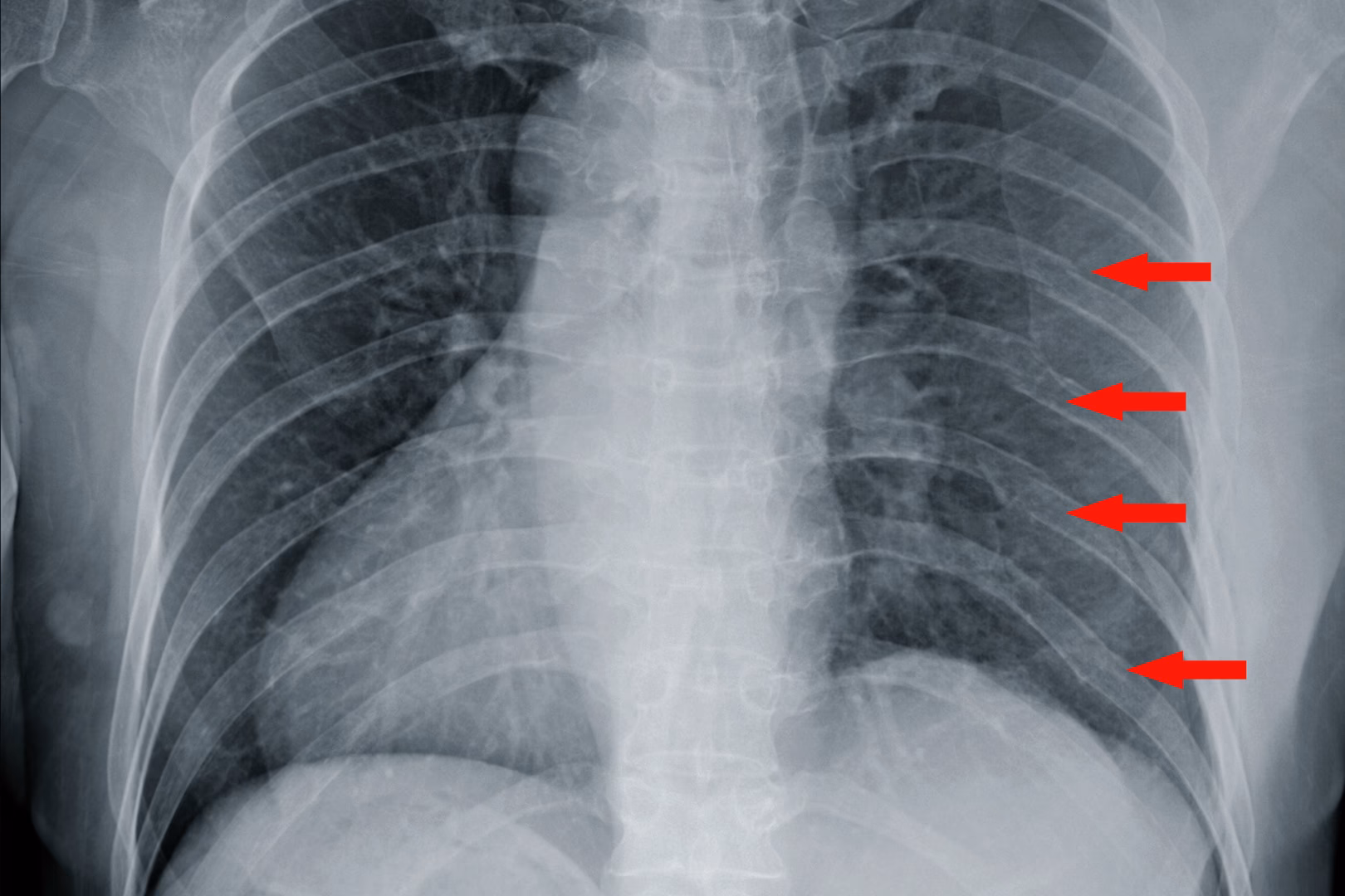 How long does it take a broken rib to heal?