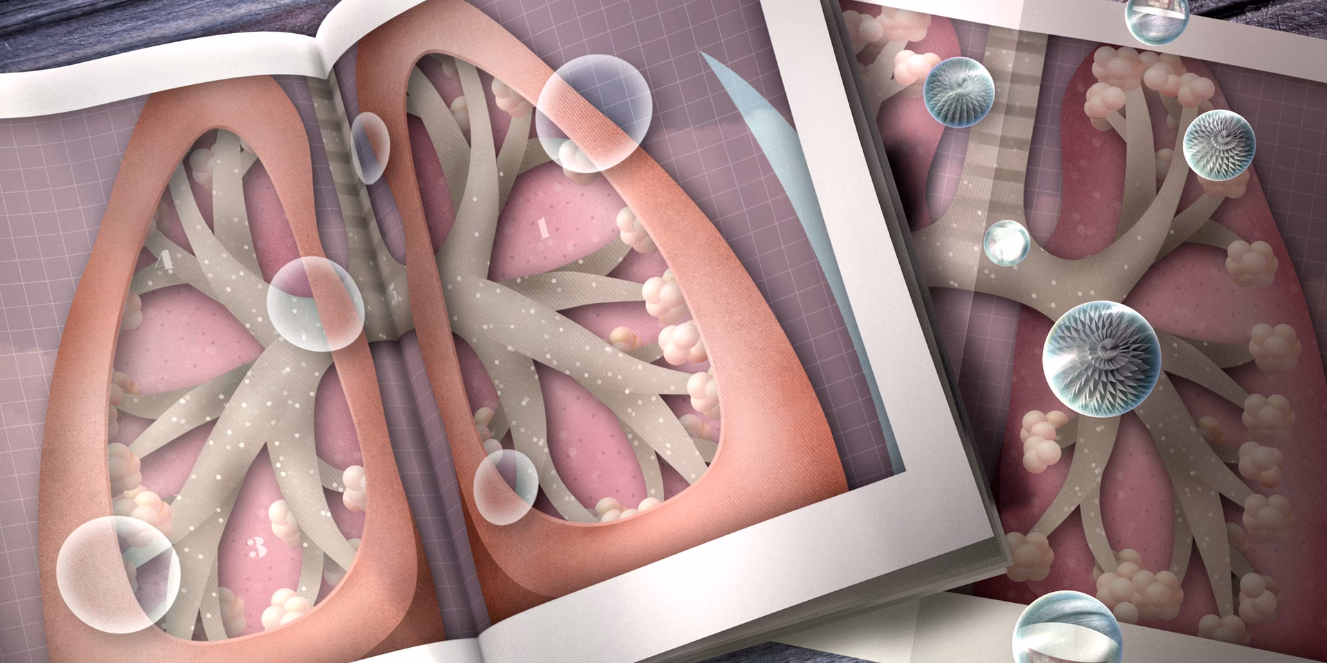 What causes acute bronchiolitis in infants and babies?